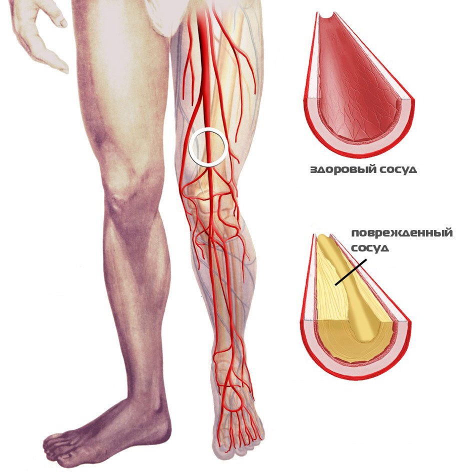 Болезни артерий нижних конечностей и УЗИ