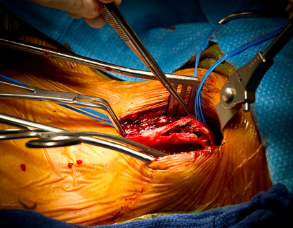 Дуплексное сканирование сонных артерий после стентирования или эндартерэктомии