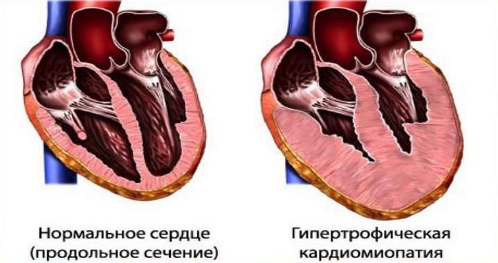 УЗИ сердца в диагностике кардиомиопатии