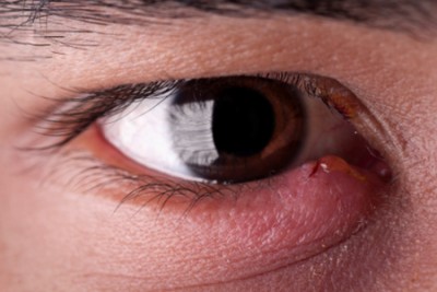 Халязион у детей