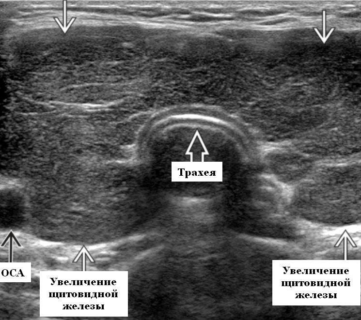 Аплазия щитовидной железы. Структура нормальной щитовидной железы на УЗИ. УЗИ щитовидной железы эхограммы. Ультразвук щитовидной железы. Подострый тиреоидит щитовидной железы УЗИ картина.