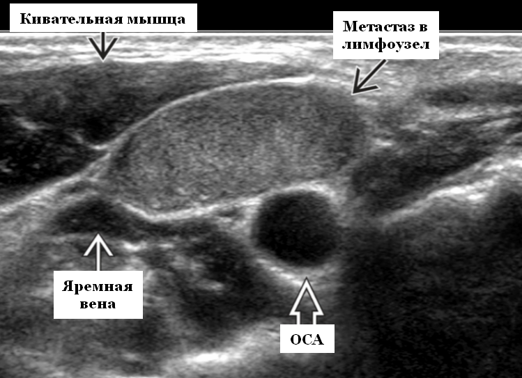Метастатические лимфоузлы. Медуллярная опухоль щитовидной железы УЗИ. Карцинома щитовидной железы УЗИ. Лимфатический узел щитовидной железы УЗИ. Лимфома щитовидной железы на УЗИ.